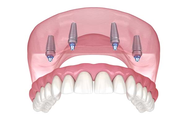 All On  ® Vs  Dental Bridges Vs  Traditional Dentures