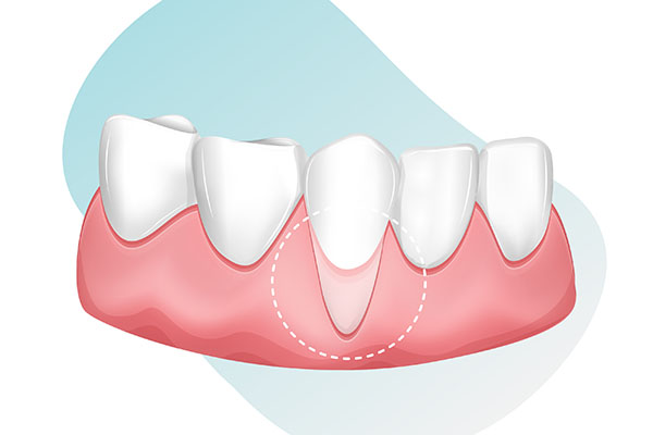 Common Causes of Receding Gums from Blossom River Dental in San Jose, CA