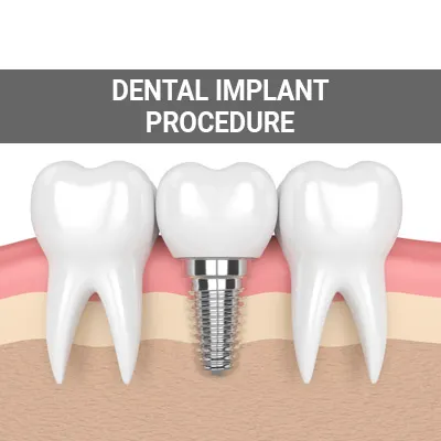 Visit our The Dental Implant Procedure page