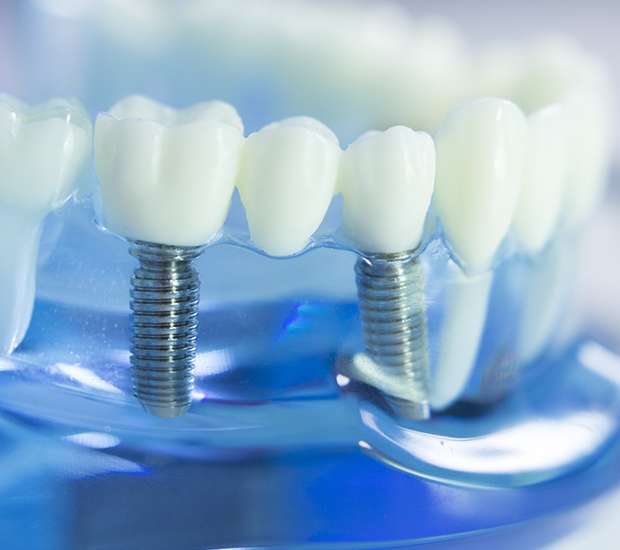 San Jose Dental Implants