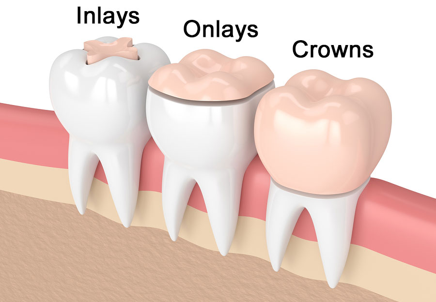 inlay and onlay